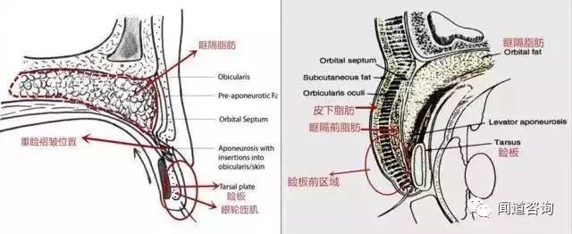 眶隔脂肪向下延伸到睑板前,同时皮下和眶隔前都有明显的脂肪成分(看涂