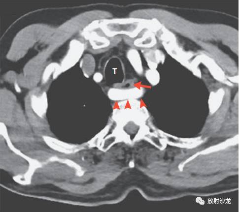胸部增强ct发现异位右锁骨下动脉(图2,楔形符号所示,t为气管),食管