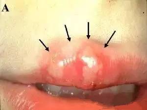 【疱疹案例】不打针不吃药5天消灭宝宝的病毒性疱疹