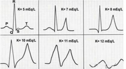一份心电图就能诊断血钾异常,学出新高度!