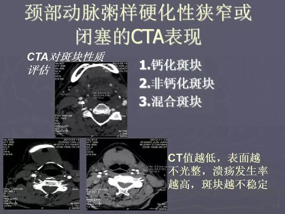 介入医学课件│颈部血管cta成像的临床应用