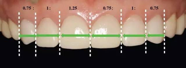 max zircad)】 最终美学效果分析 图29 上前牙牙龈曲线(牙龈高点对称)