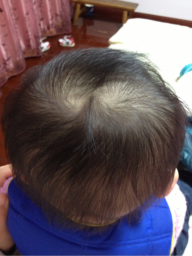 毛流在头顶可形成一个中心向外,周围头发呈旋涡状的排列,俗称头旋.