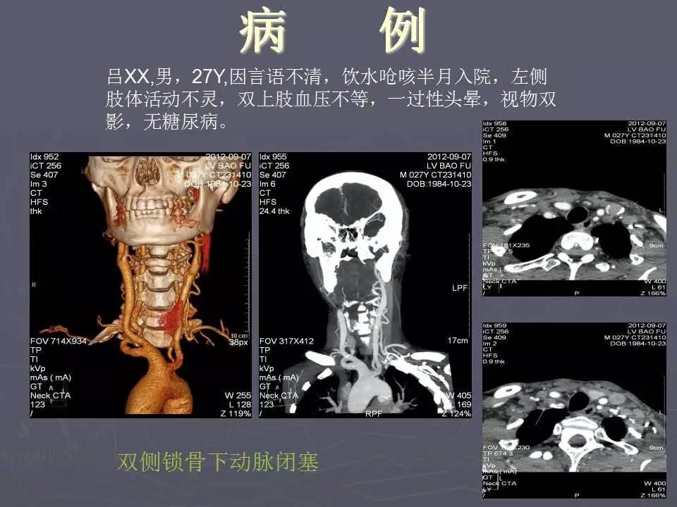 介入医学课件│颈部血管cta成像的临床应用