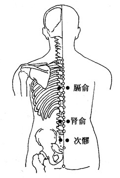 拔罐治腰椎间盘突出症效果让你想不到