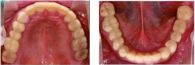 【2016csed口腔美学临床病例展评金奖】全口牙列重度磨耗的美学和功能