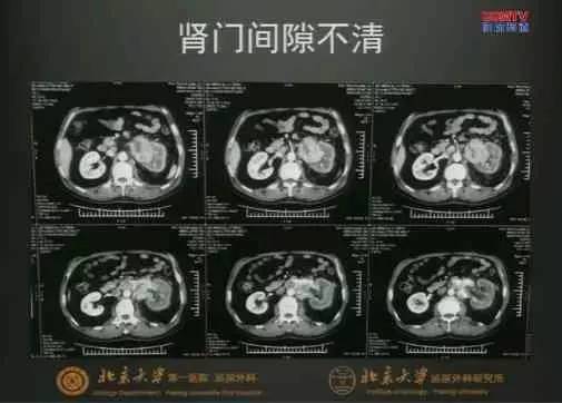 肾癌伴下腔静脉癌栓处理经验分享