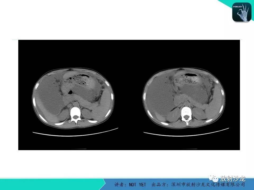 【每日一例 423期】结核性腹膜炎