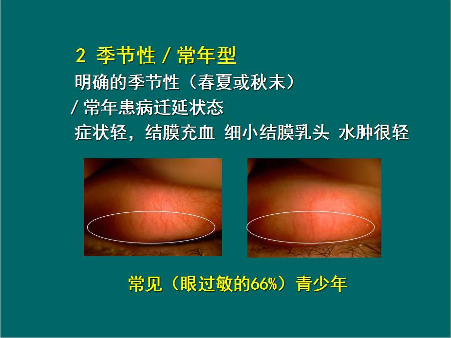 【再回首,我的2016】过敏性结膜炎的治疗