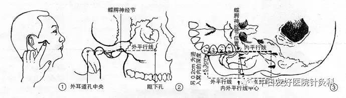 鼻炎患者的福音!针刀结合蝶腭神经节刺激术治疗各型鼻炎疗效显著!