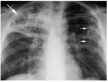 图7 结核分枝杆菌感染的支气管内膜播散胸部正位片可见右肺上叶空洞