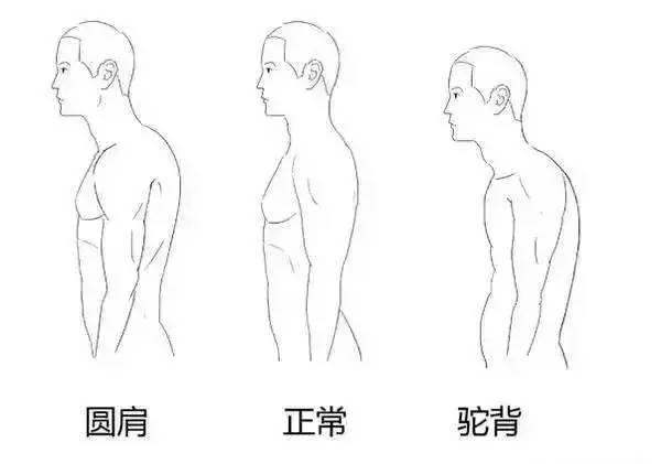 第二类背厚的原因,现在越来越常见了,就是 圆肩驼背.