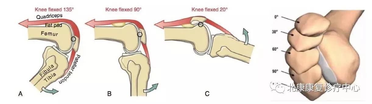 屈膝60°-90°:髌骨完全位于股骨髁间沟内,关节面接触面积最大;屈膝20