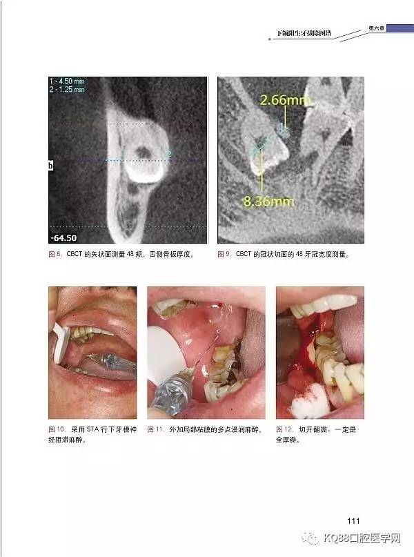 即买即发张东星新书微创拔牙及口腔门诊小手术实用图谱