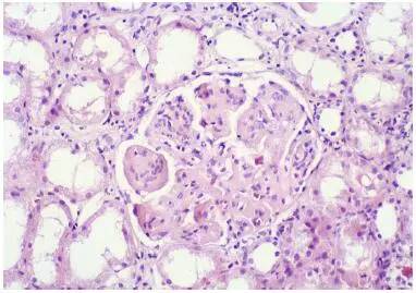 病理图解Ⅲ型胶原肾小球病