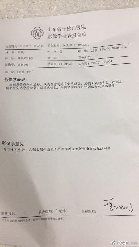 崔巍预备队比赛受伤,被查出鼻骨多发骨折