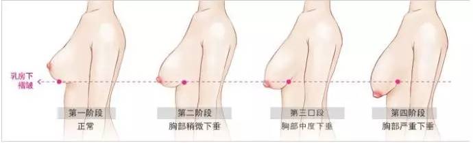 乳房小下垂怎么办