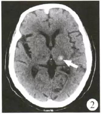 一例被误诊为脑肿瘤的脑出血mri,你会犯这种错误吗?附误诊分析