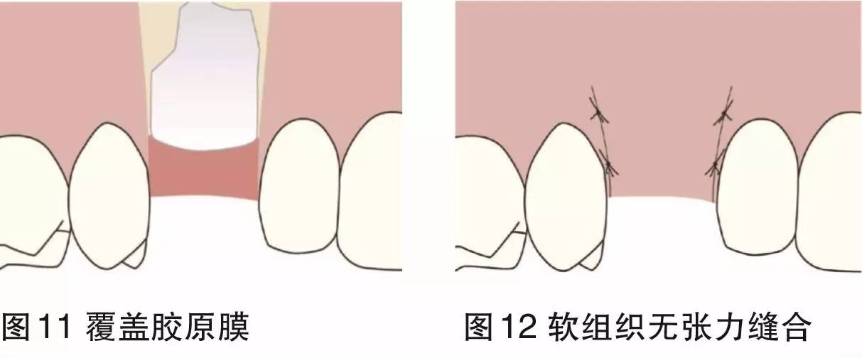 骨环植骨在种植中的应用——陈钢医师