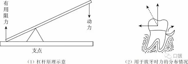 拔牙挺的辨别和使用