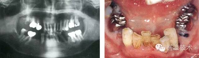 全口拔牙即戴全口活动义齿修复病例