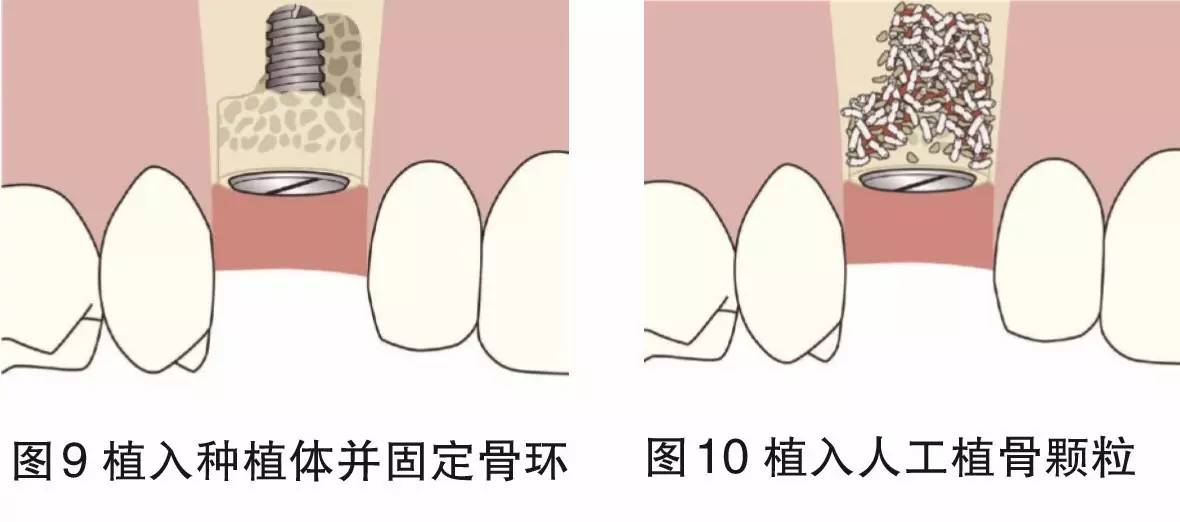 骨环植骨在种植中的应用——陈钢医师