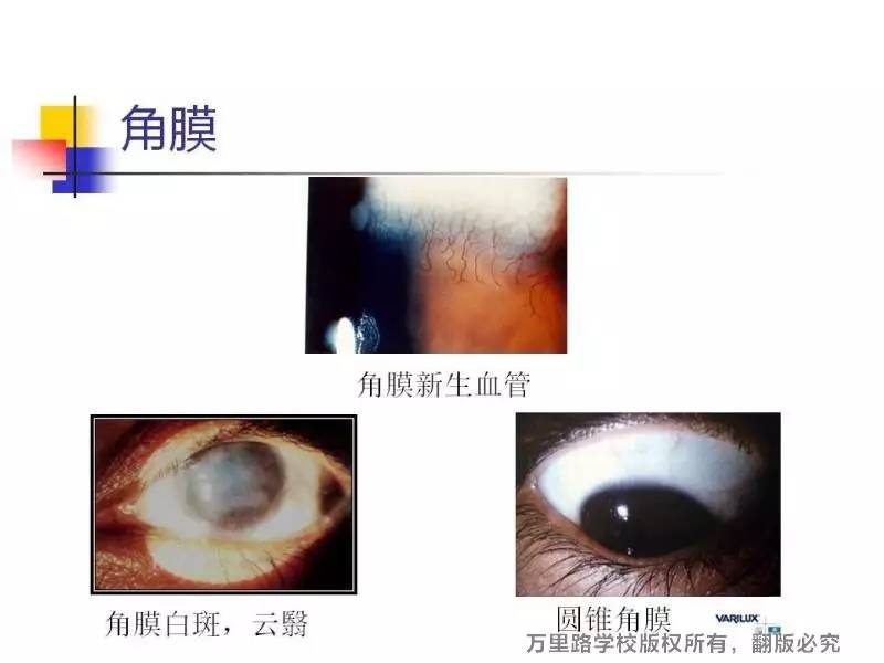 我们是需要观察角膜的透明度,光滑度和角膜上无角膜新生血管;角巩膜缘