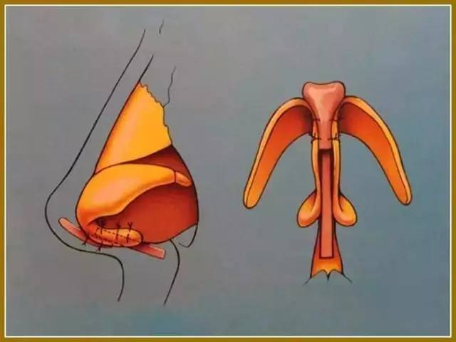 创美国际美学干货自体软骨鼻综合整形术图示