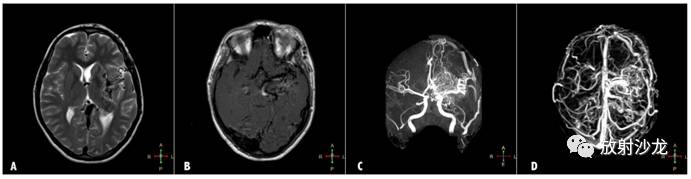 一文打尽|关于颅内血管畸形,你想知道的都在这里(下)