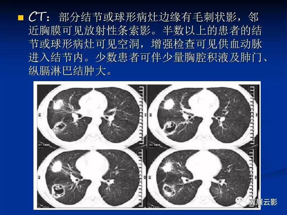 肺转移瘤与韦格肉芽肿的鉴别
