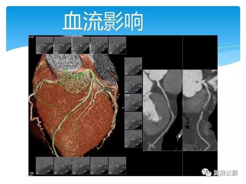 冠状动脉狭窄的鉴别诊断