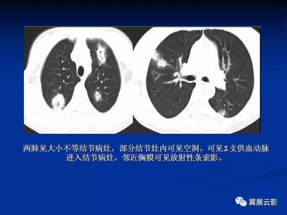 肺转移瘤与韦格肉芽肿的鉴别