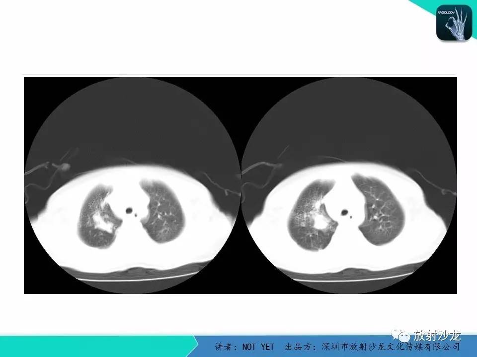 【每日一例 | 427期】原发性肺结核