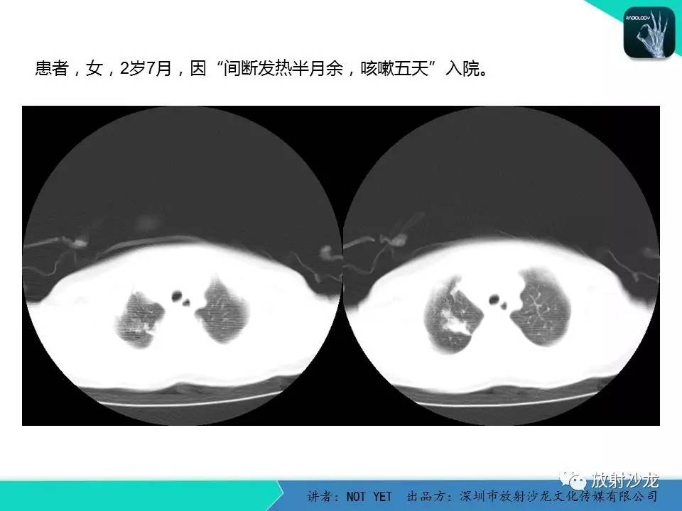 【每日一例 | 427期】原发性肺结核