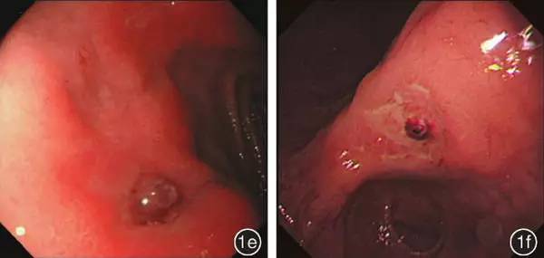 多图|消化性溃疡病出血征象forrest分级镜下表现
