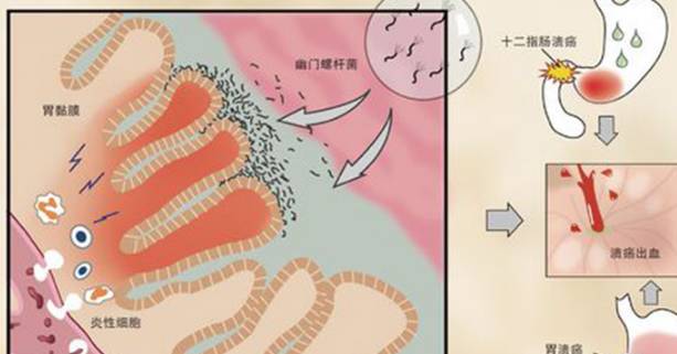 引发hp(幽门螺杆菌)入侵的五个因素 共餐