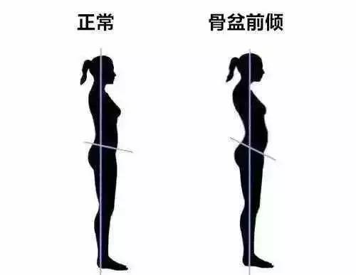 你以为的翘臀90是骨盆前倾对女性危害不小