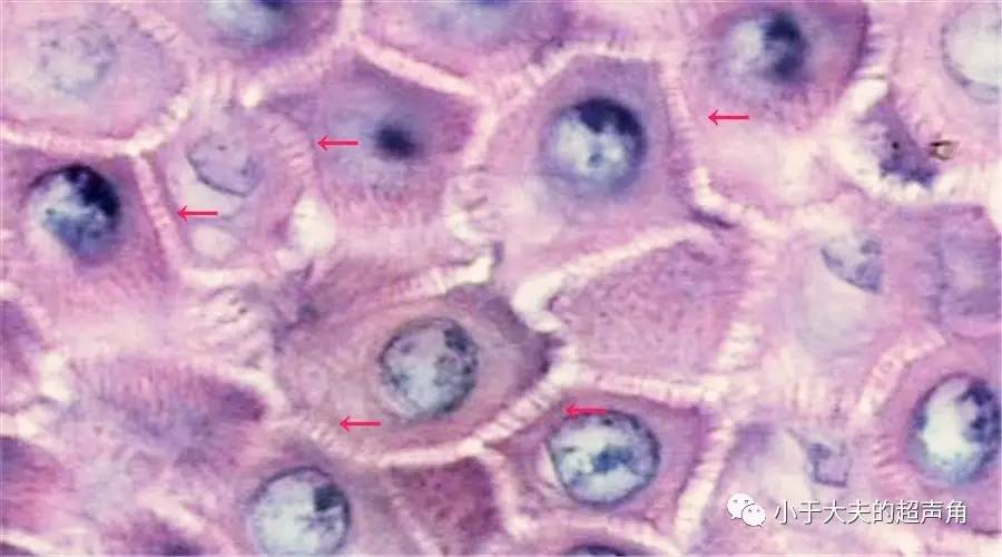 【皮肤超声】老人们常说的"翻花疮":鳞状细胞癌