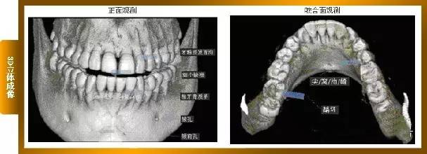 种植牙与口腔ct检查 你知道多少?