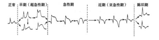 3,心肌梗死的演变和分期