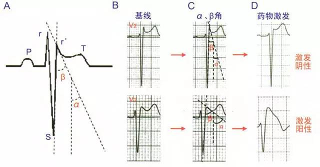 β角和α角形成的示意图;b:药物激发试验前两者基线状态时v2导联心电