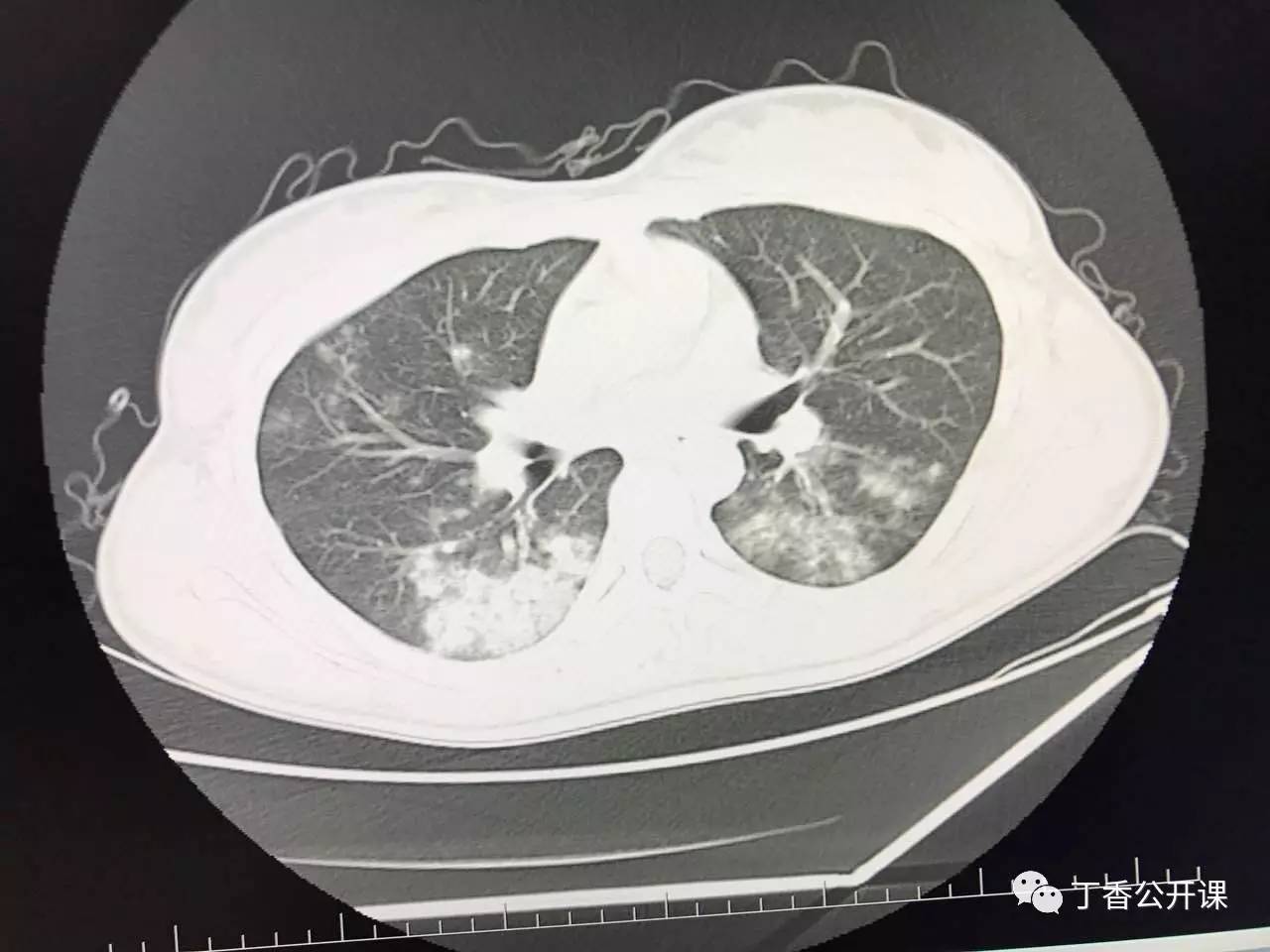 肺大泡ct图解,肺大泡在t上的图像,肺大泡t图片解读_大山谷图库