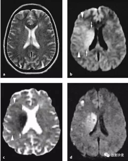 脑梗死mri表现(发病2小时)