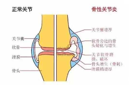 骨关节炎关节发炎