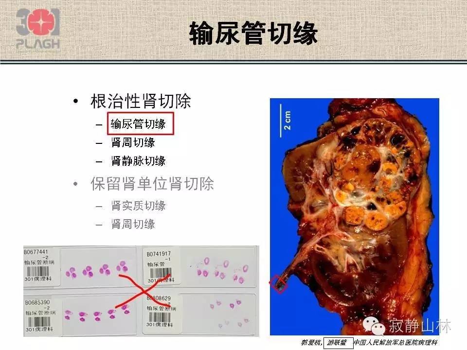 肾脏标本的病理操作常规