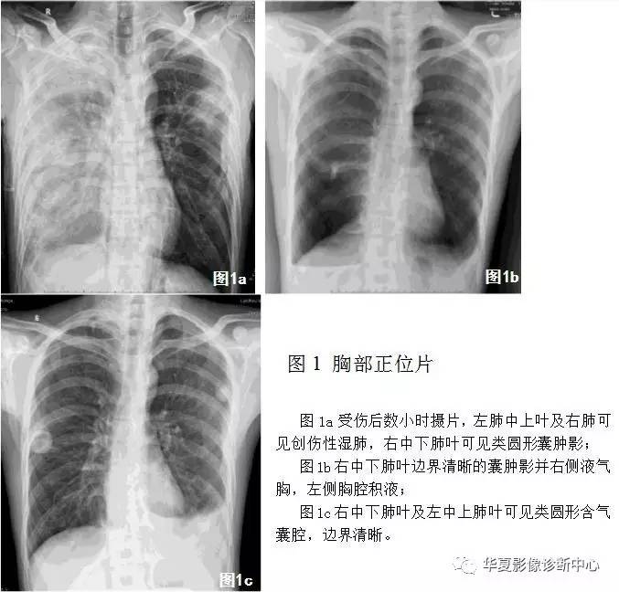 肺部有肺气囊怎么办呢