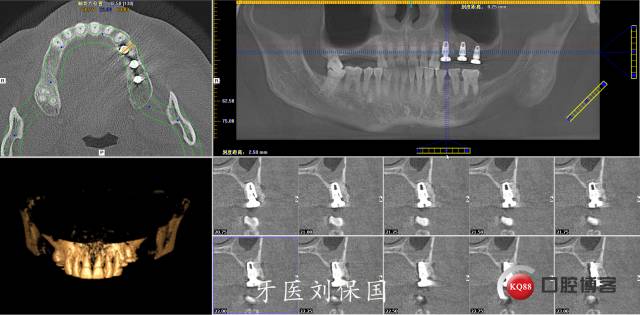 常规拔除患牙,清创,冲洗,先锋钻定位,逐级扩孔,在25,26位置行上颌窦