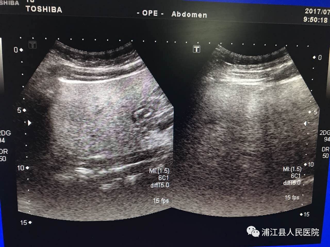 医学|让宝宝远离脂肪肝