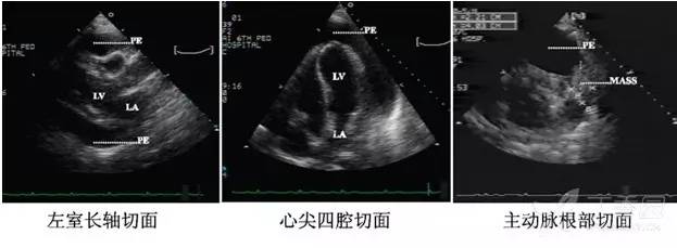 进阶必备:超声心动图报告单解读(常见疾病篇)