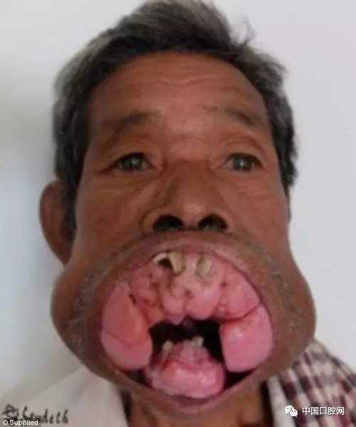 英格昆的整个口腔都被增生的牙龈覆盖,以至于嘴巴不能闭合,朝前凸出